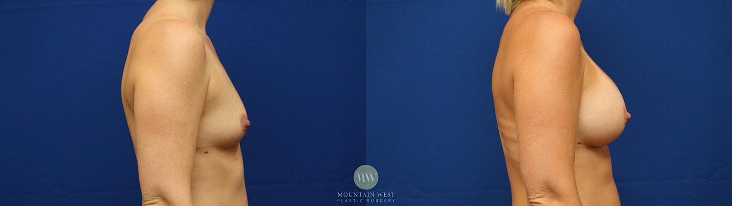 Breast Augmentation Before & After