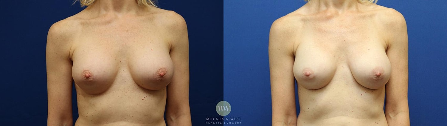 Breast Augmentation Before & After