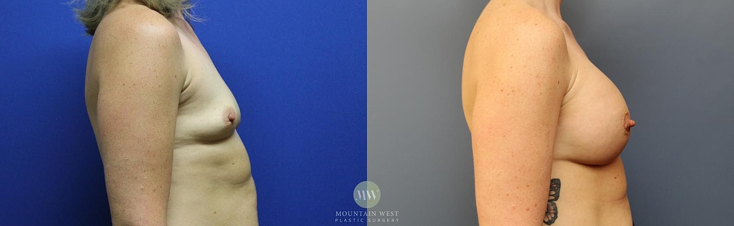 Breast Augmentation Before & After
