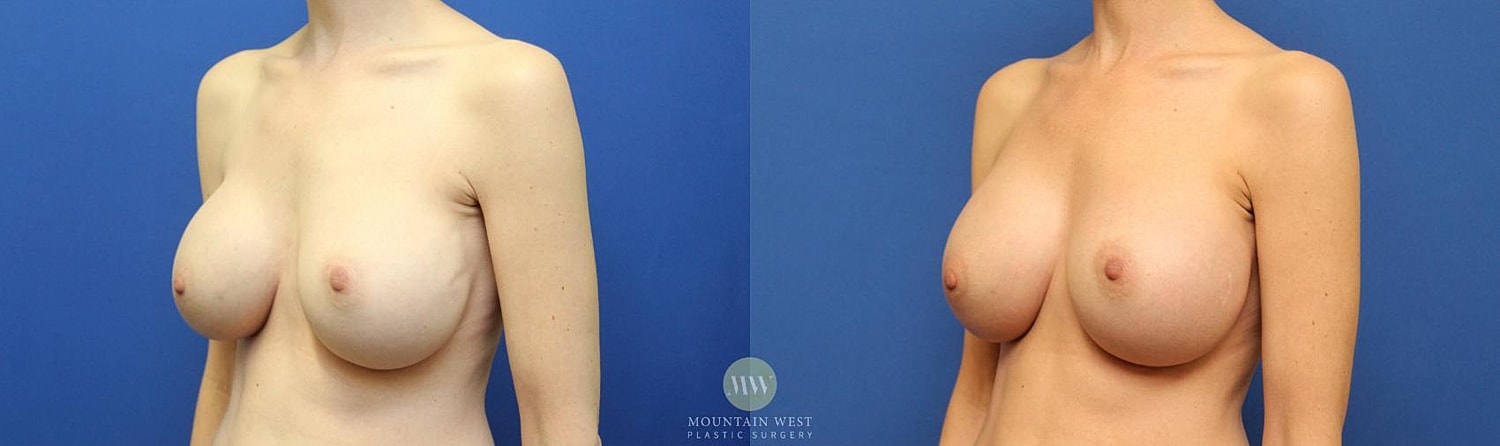 Breast Augmentation Before & After