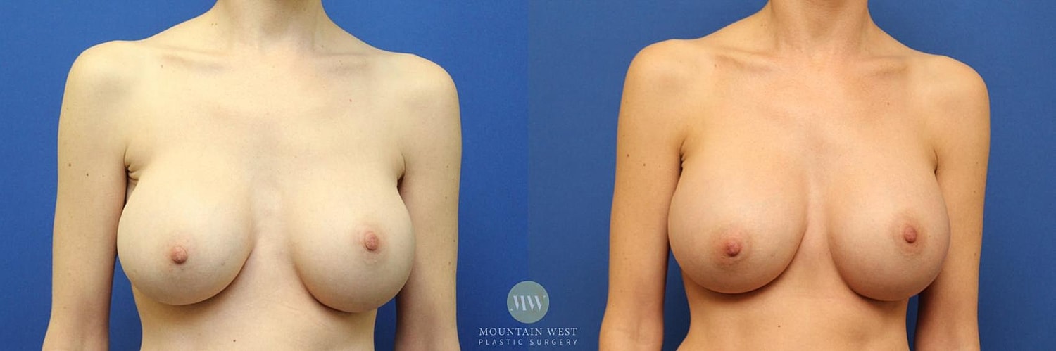 Breast Augmentation Before & After