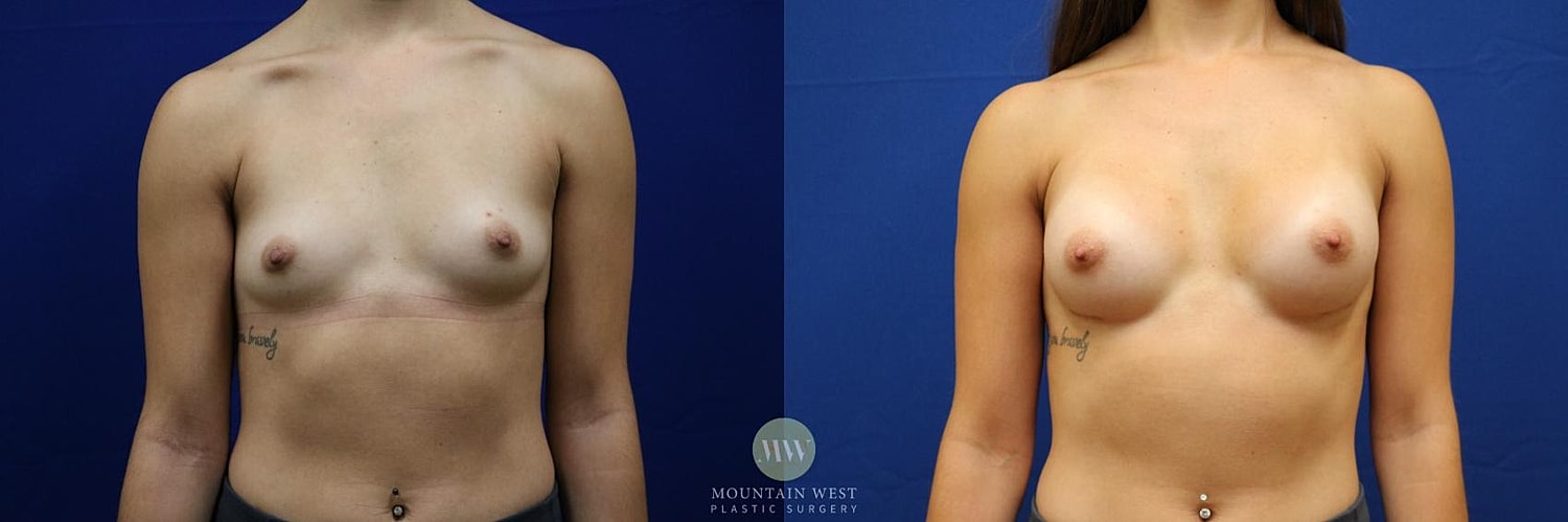Breast Augmentation Before & After
