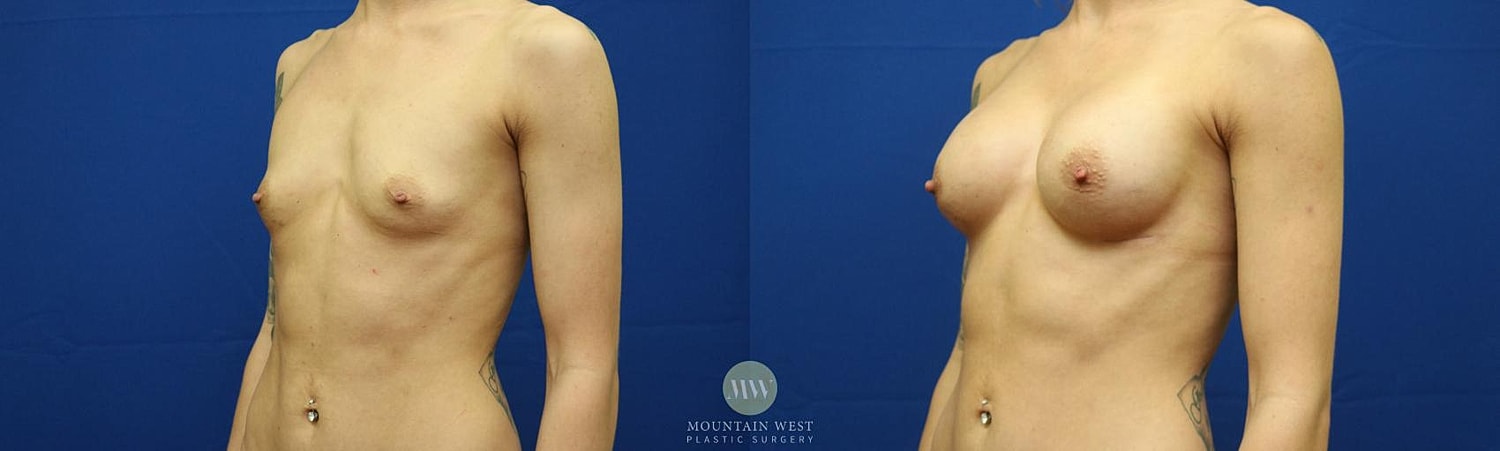 Breast Augmentation Before & After