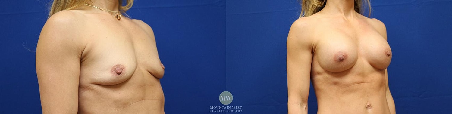 Breast Augmentation Before & After