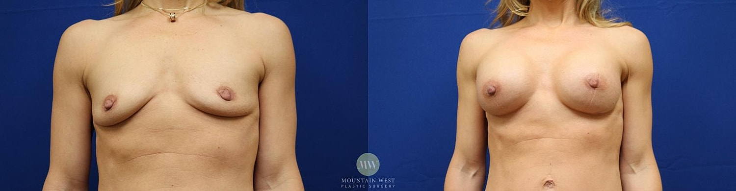 Breast Augmentation Before & After