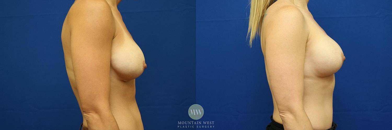 Breast Augmentation Before & After