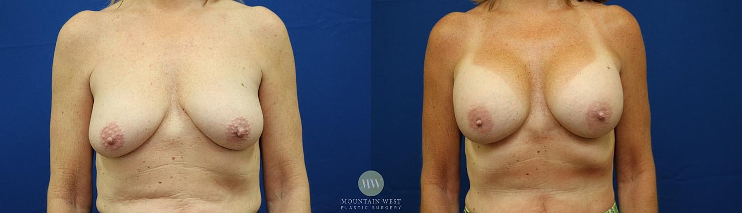 Breast Augmentation Before & After