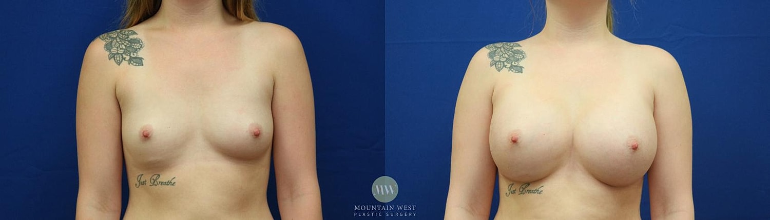 Breast Augmentation Before & After