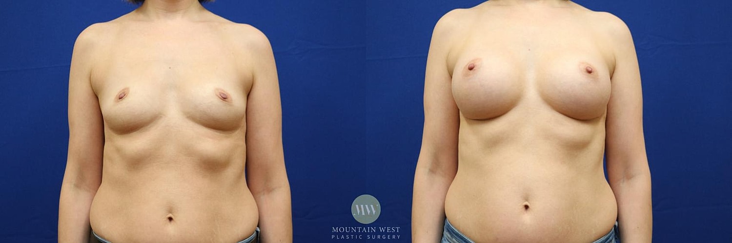 Breast Augmentation Before & After