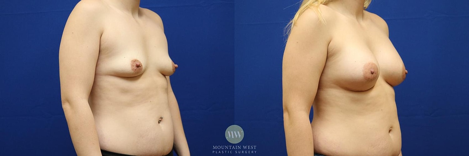 Breast Augmentation Before & After