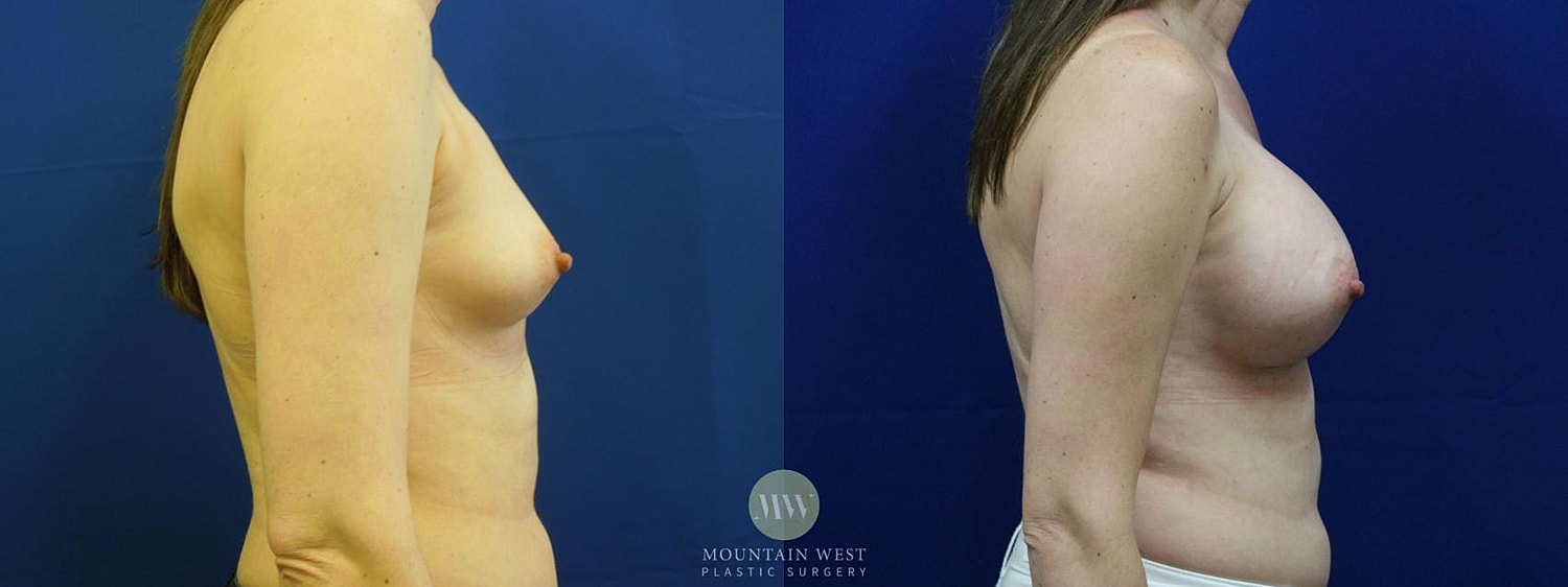 Breast Augmentation Before & After