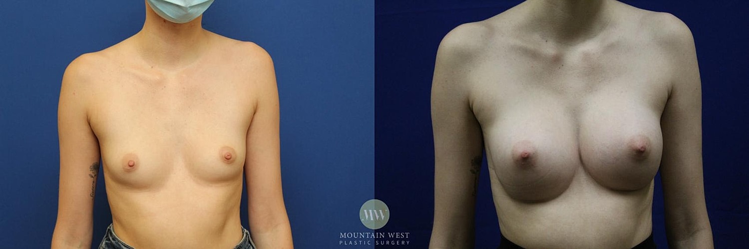 Breast Augmentation Before & After