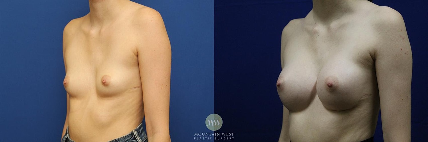 Breast Augmentation Before & After