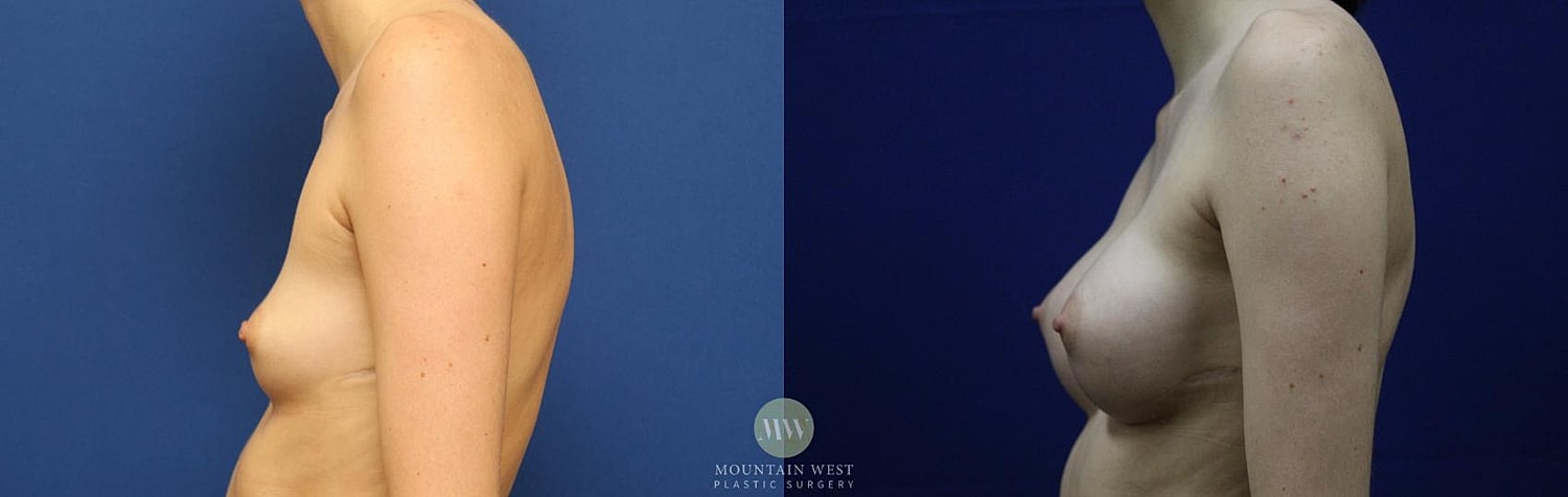 Breast Augmentation Before & After