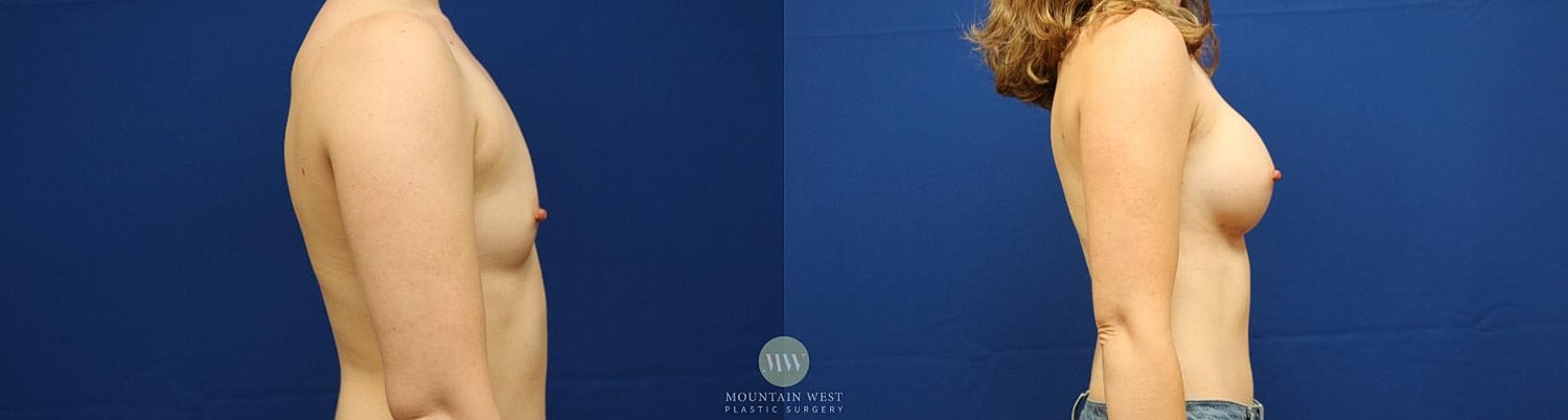 Breast Augmentation Before & After