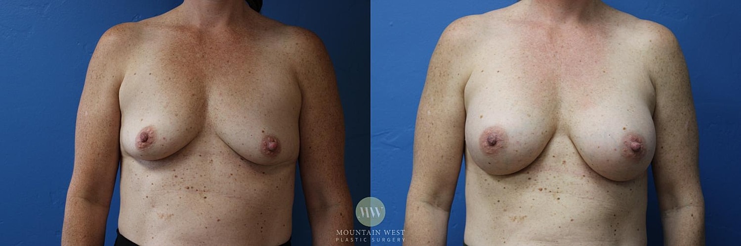 Breast Augmentation Before & After