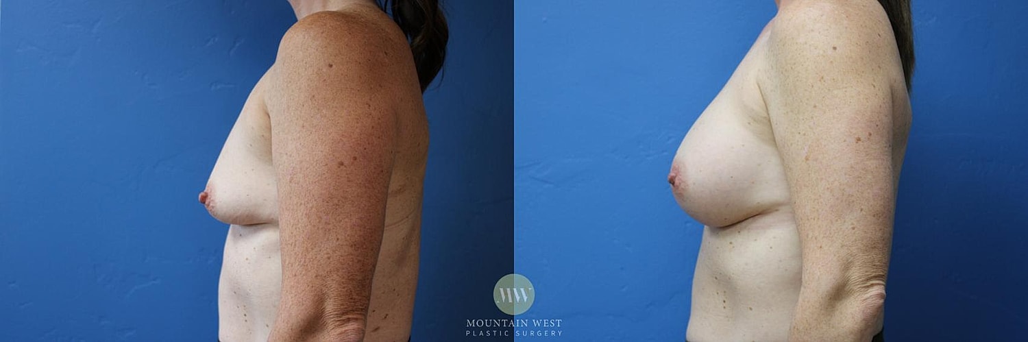 Breast Augmentation Before & After