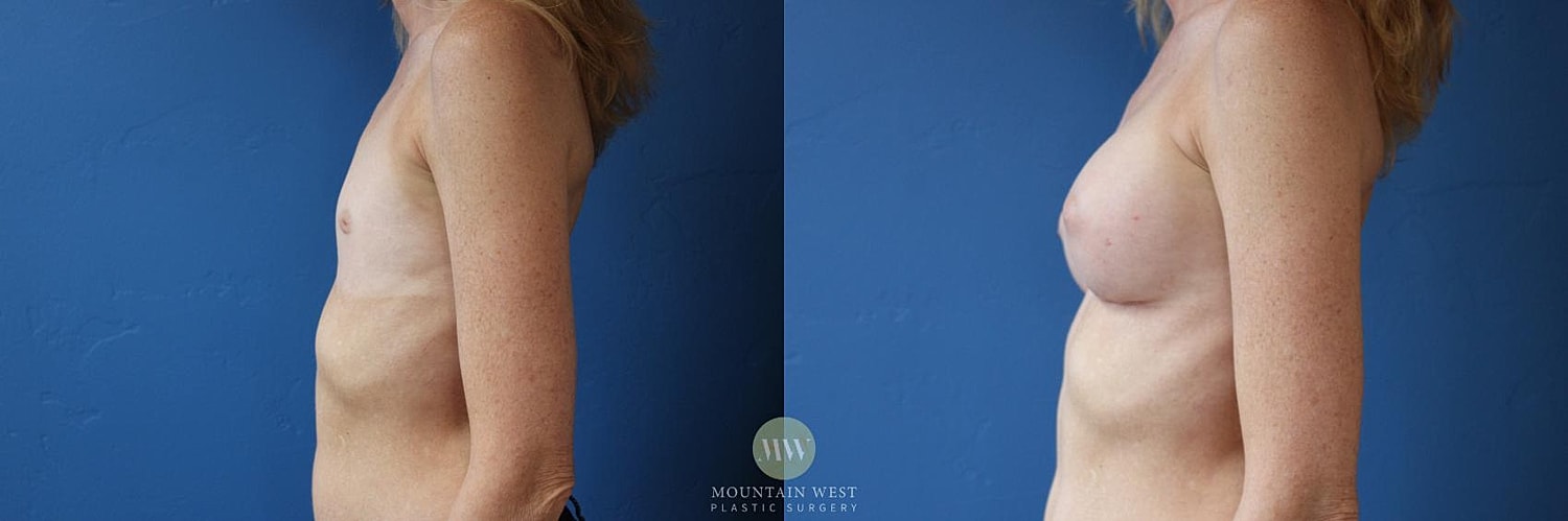 Breast Augmentation Before & After