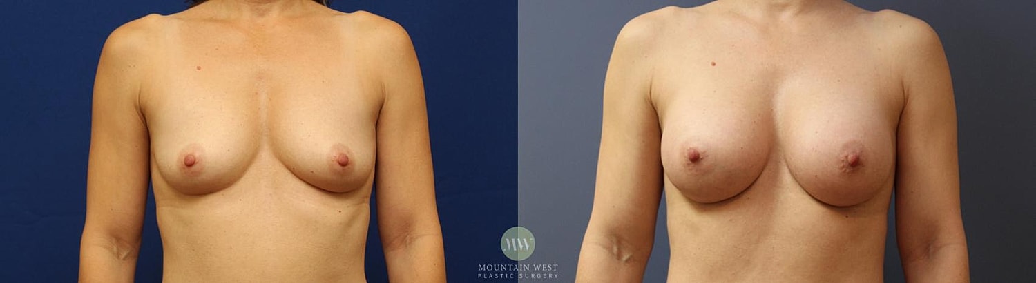 Breast Augmentation Before & After