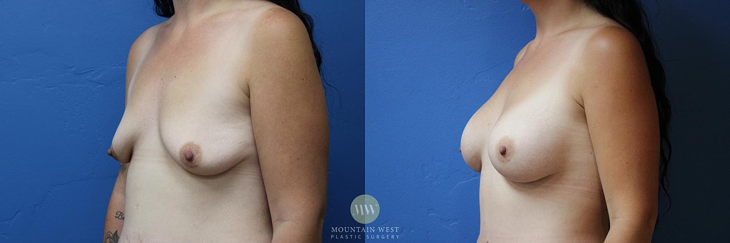 Breast Augmentation Before & After
