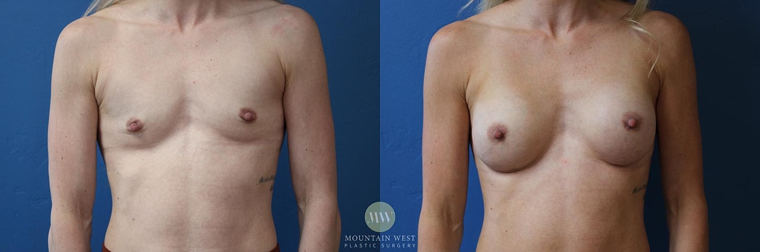 Breast Augmentation Before & After