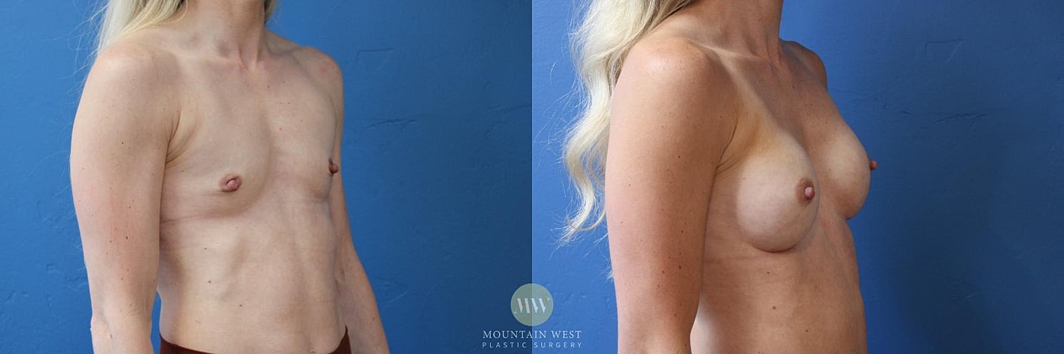 Breast Augmentation Before & After