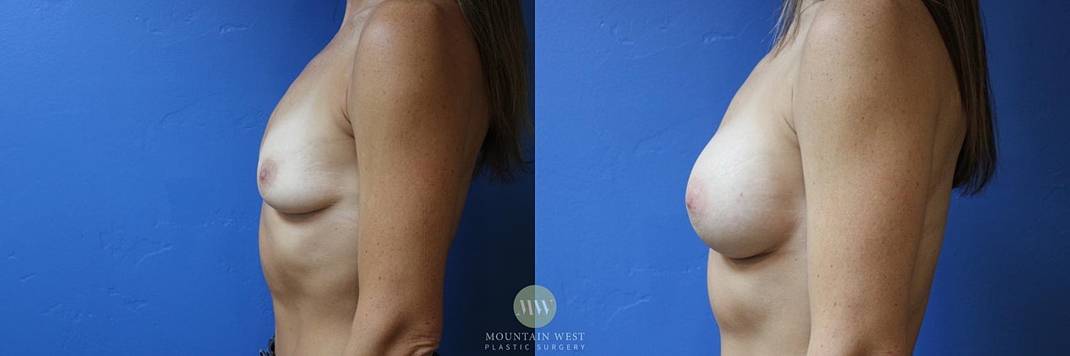 Breast Augmentation Before & After