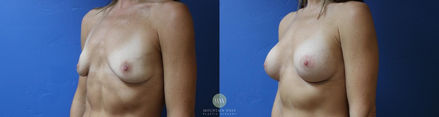 Breast Augmentation Before & After