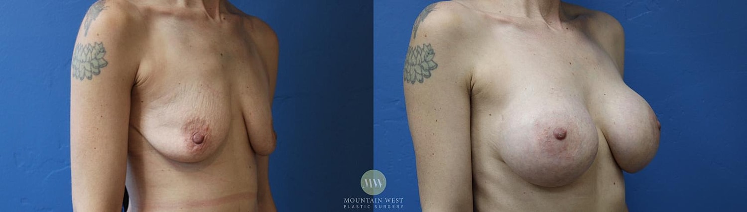 Breast Augmentation Before & After