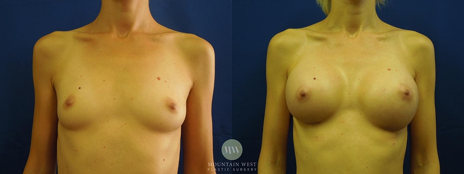 Breast Augmentation Before & After