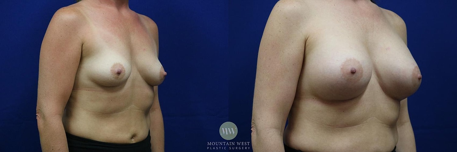 Breast Augmentation Before & After