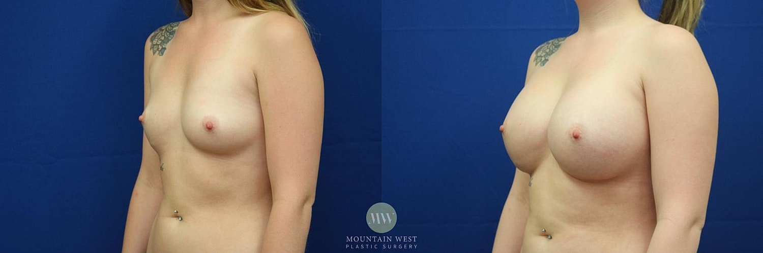 Breast Augmentation Before & After