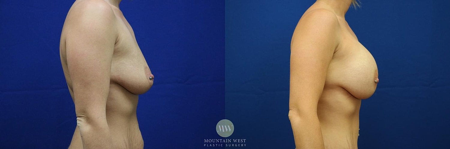 Breast Augmentation Before & After