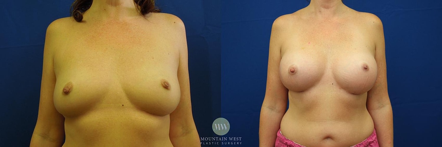 Breast Augmentation Before & After