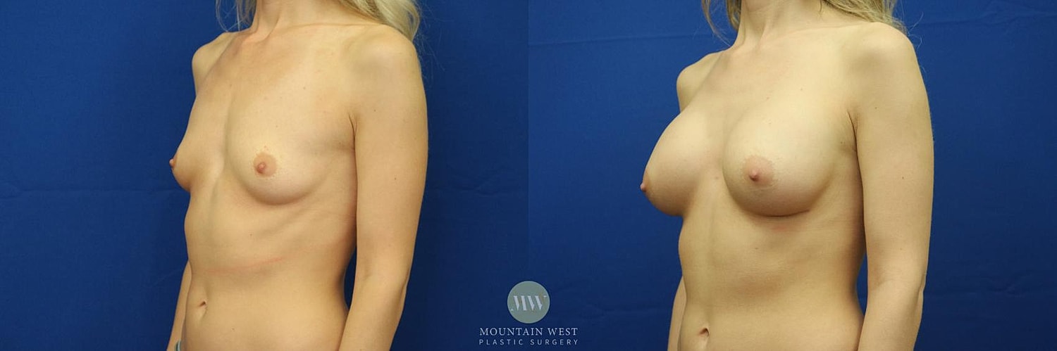 Breast Augmentation Before & After