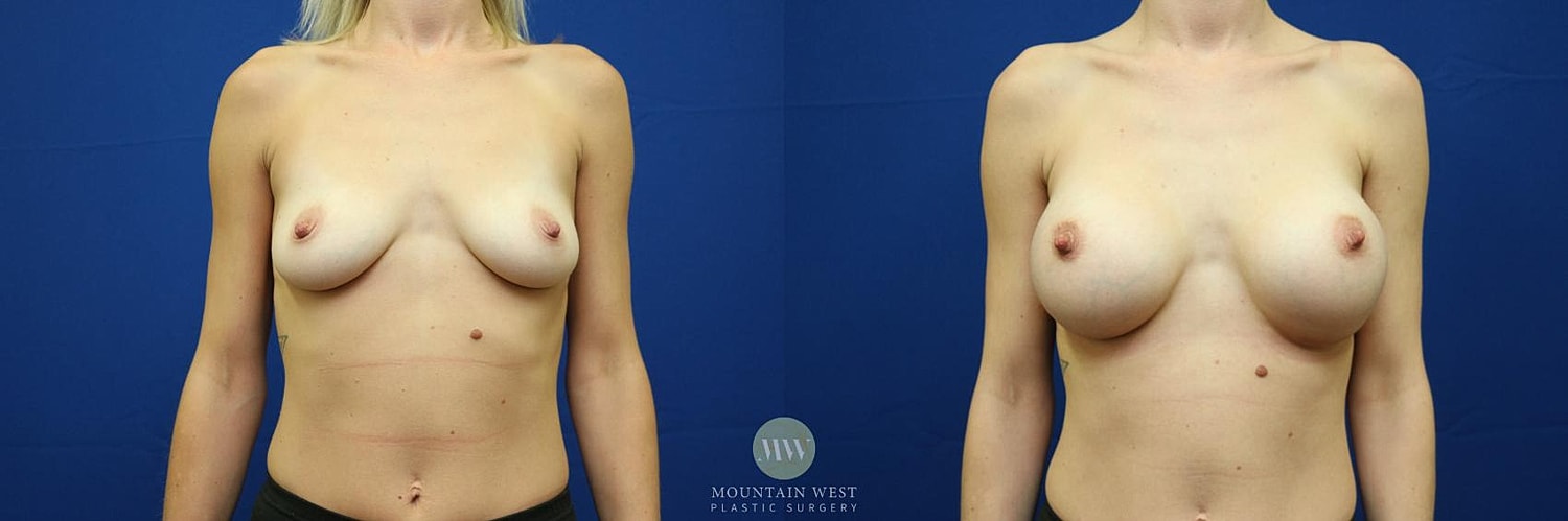 Breast Augmentation Before & After