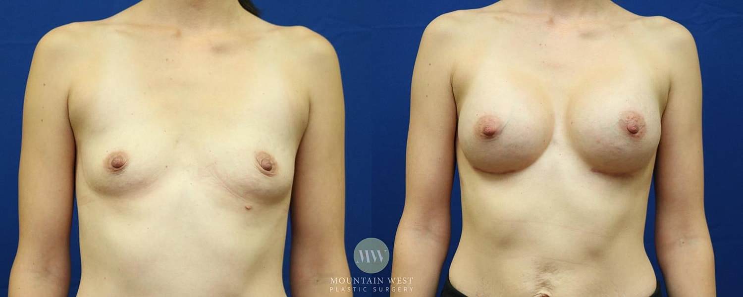 Breast Augmentation Before & After
