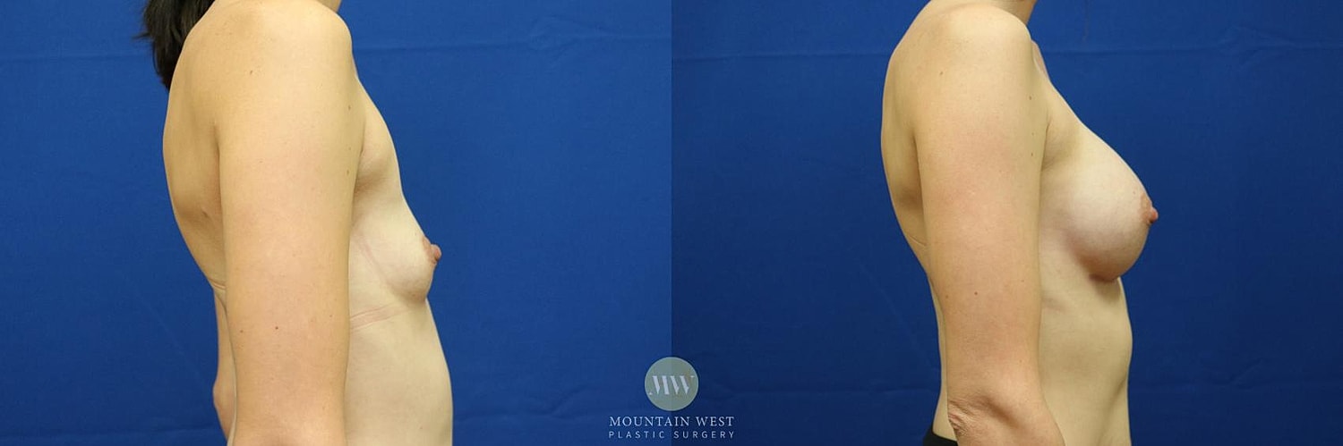Breast Augmentation Before & After