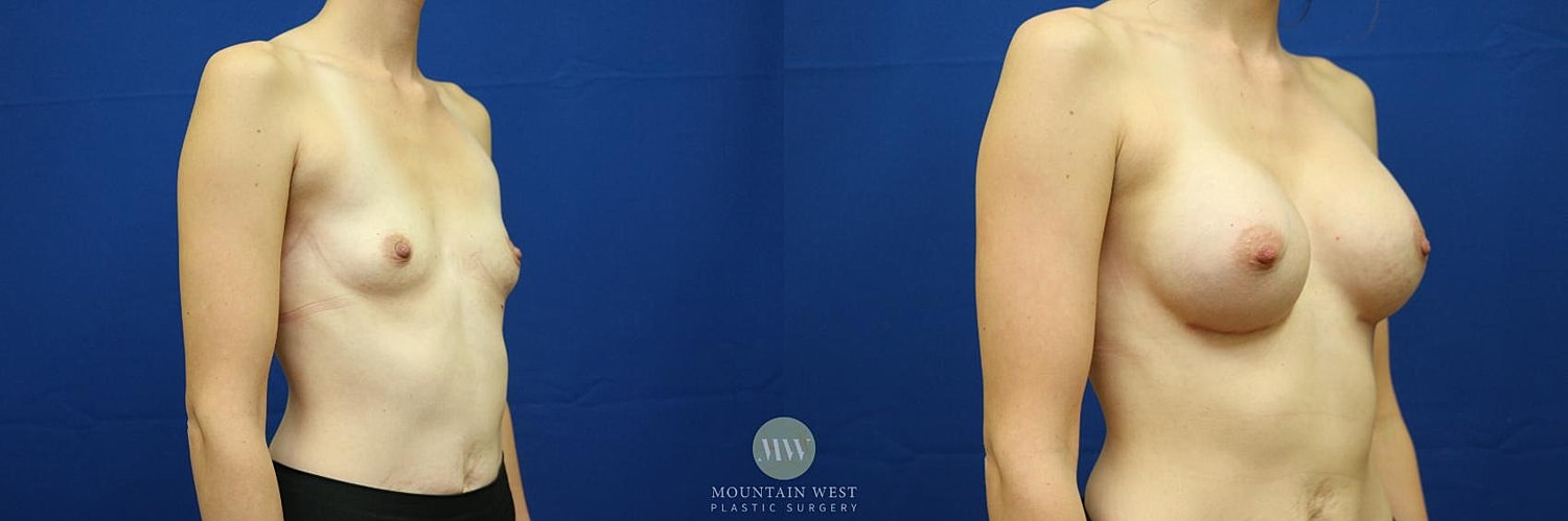 Breast Augmentation Before & After
