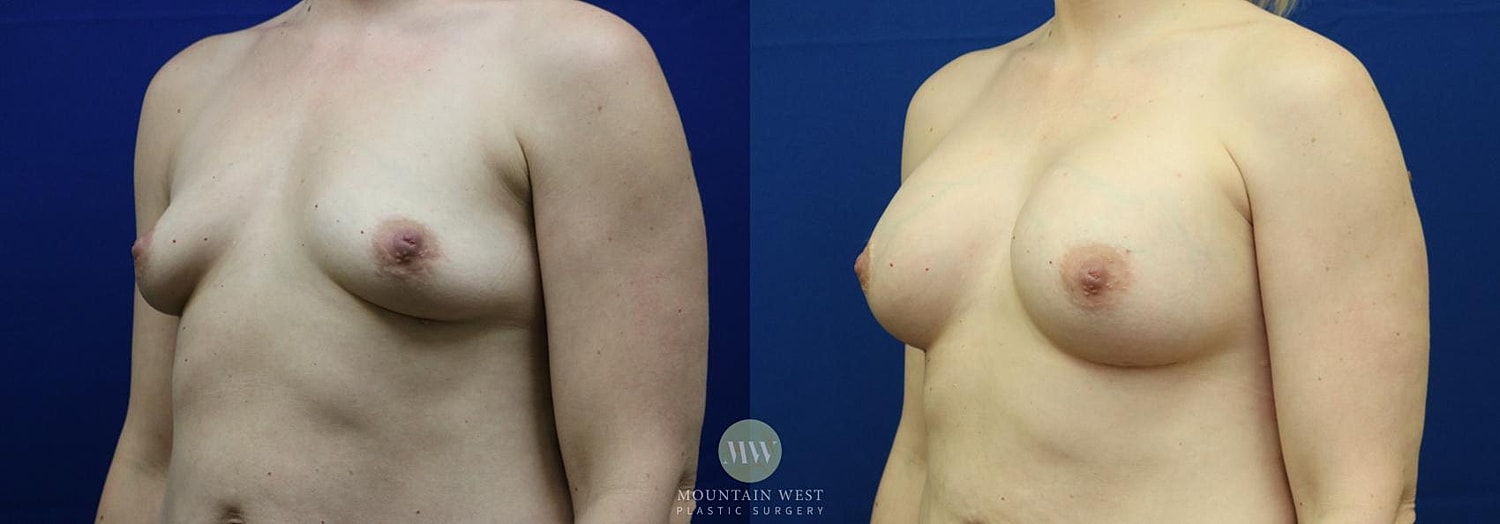Breast Augmentation Before & After