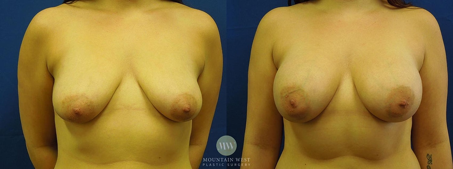 Breast Augmentation Before & After