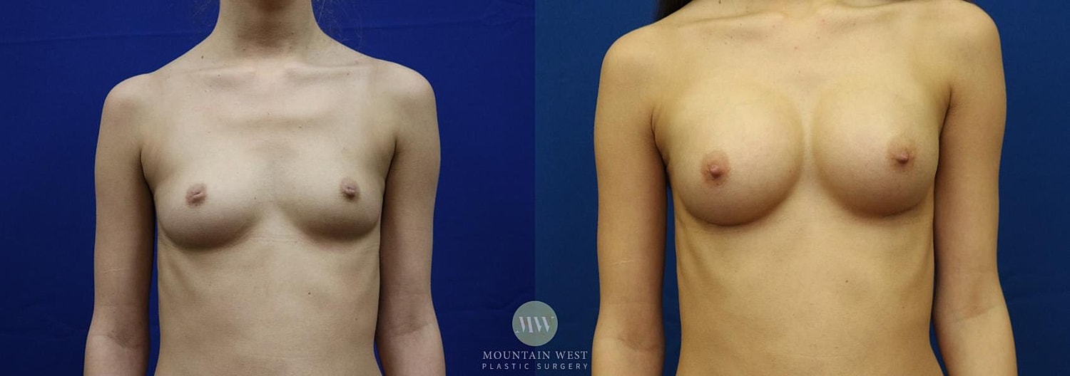 Breast Augmentation Before & After