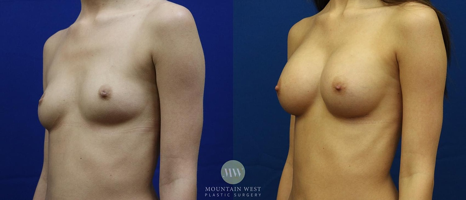 Breast Augmentation Before & After