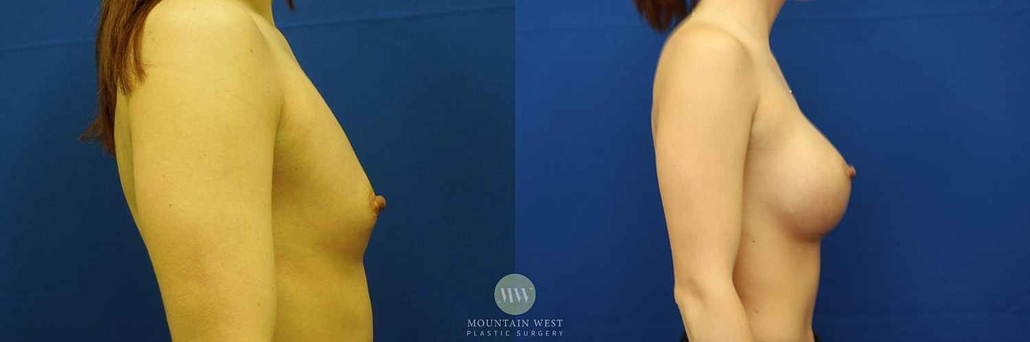 Breast Augmentation Before & After