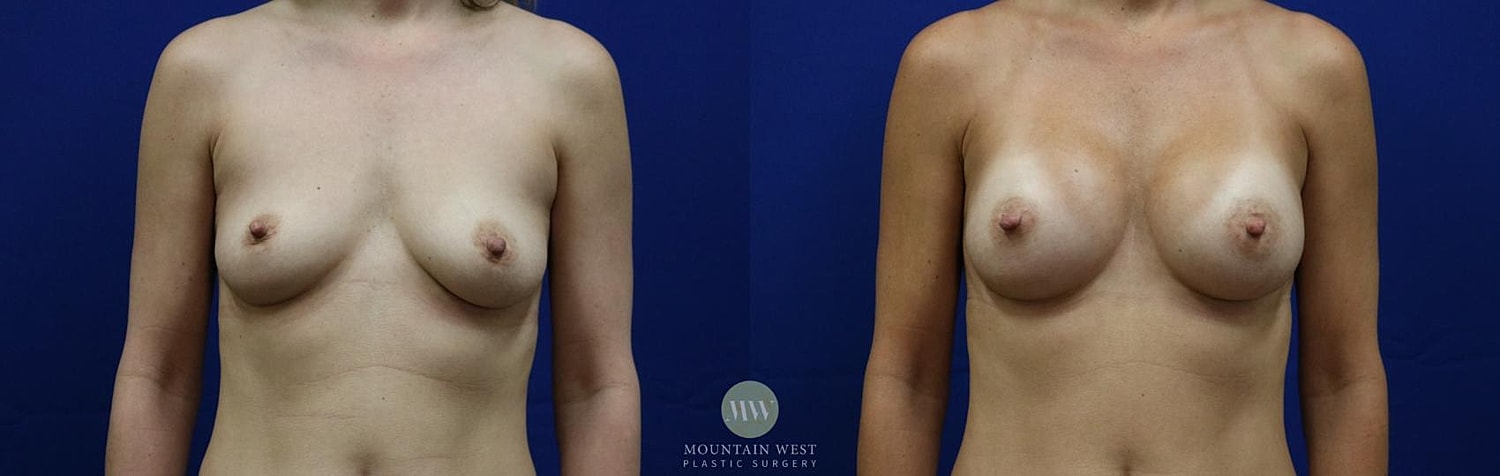 Breast Augmentation Before & After