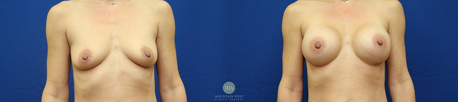Breast Augmentation Before & After