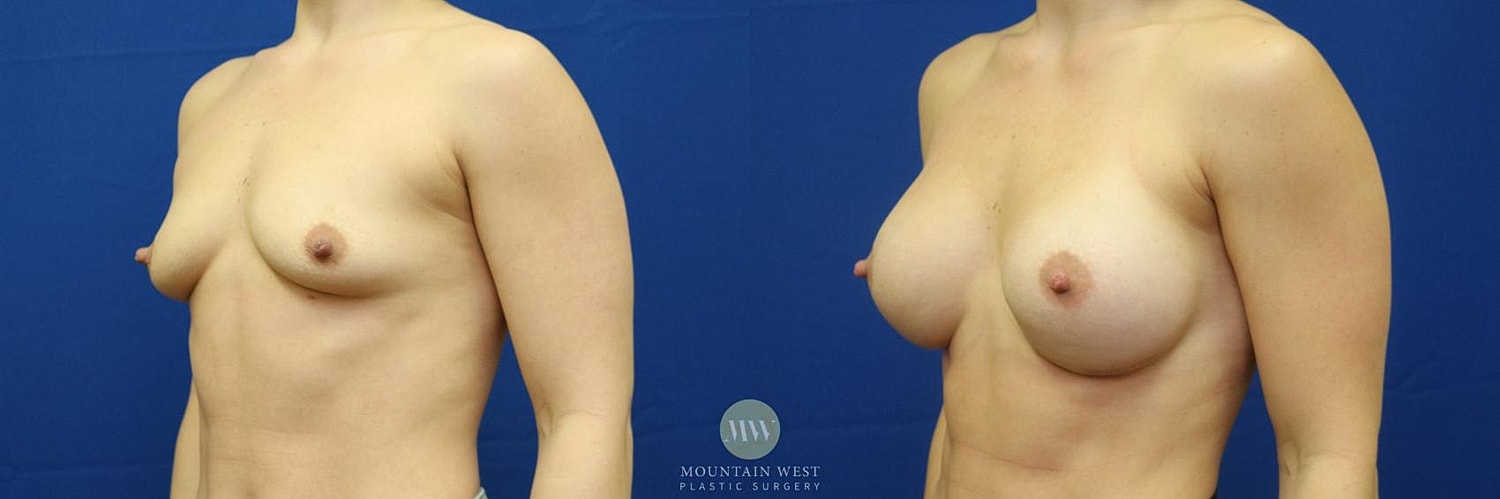 Breast Augmentation Before & After