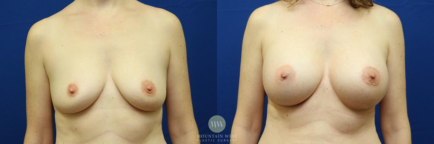 Breast Augmentation Before & After