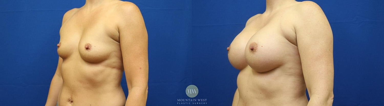 Breast Augmentation Before & After