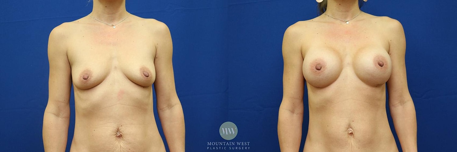 Breast Augmentation Before & After